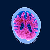 Brain in dementia, CT scan