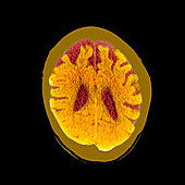 Brain in dementia, CT scan
