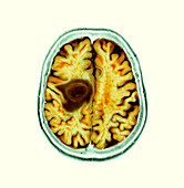 Glioblastoma brain cancer, CT scan