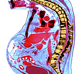 Spine in ankylosing spondylitis, X-ray