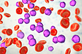 Acute lymphoblastic leukaemia smear, illustration