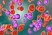 Acute lymphoblastic leukaemia smear, illustration