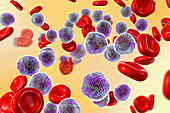 Acute lymphoblastic leukaemia smear, illustration