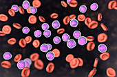 Acute lymphoblastic leukaemia smear, illustration