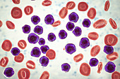 Acute lymphoblastic leukaemia smear, illustration