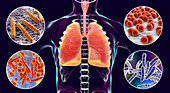 Bacteria that cause lung infections, illustration