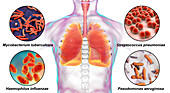 Bacteria that cause lung infections, illustration