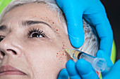 Platelet-rich plasma facial treatment