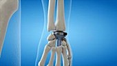 Wrist implant animation