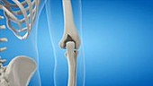 Elbow implant animation