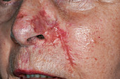 Scar after basal cell carcinoma excision