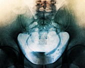 Ureterocoele,X-ray