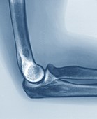 Normal elbow joint,X-ray