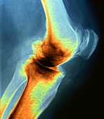 Osteoarthritis of the knee,X-ray