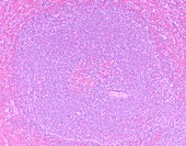 Splenic marginal zone lymphoma,light micrograph