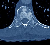 Secondary bone cancer in spinal vertebra,CT scan