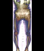 Bilateral knee osteoarthritis,X-ray