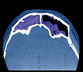 Frontal sinus infection,CT scan