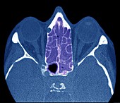 Ethmoid sinus infection,CT scan