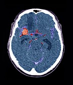 Subarachnoid haemorrhage,CT scan