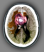 Glioblastoma cancerous brain tumour,CT scan