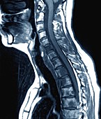 Secondary bone cancer in the spine,MRI scan