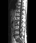 Secondary bone cancer in the spine,MRI scan