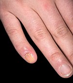 Candidiasis of a fingernail