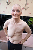 Woman who has had a mastectomy and chemotherapy