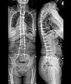 Corrected spine in osteoarthritis,X-rays