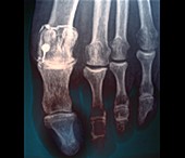 Treatment in osteoarthritis of the foot,X-ray