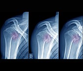 Complications following dislocated shoulder in sports injury