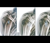 Complications following dislocated shoulder in sports injury