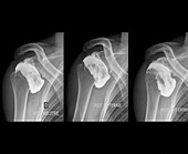 Complications following dislocated shoulder in sports injury