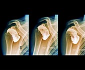 Complications following dislocated shoulder in sports injury