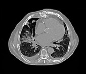 Cardiac decompensation,CT scan