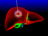 Liver cancer thermal ablation,illustration