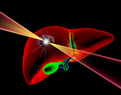 Liver cancer radiotherapy,illustration