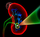 Kidney stone shock wave treatment,illustration