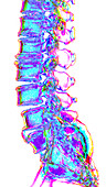 Spinal degeneration,3D CT scan