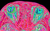 Human eyes and optic nerves,MRI scan