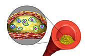 Atheromatous plaque in artery,illustration