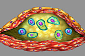 Structure of atherosclerotic plaque,illustration