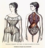 The Harmful Effects of the Corset, illustration