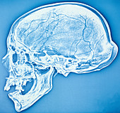 Xeroradiograph of the bathrocranic skull