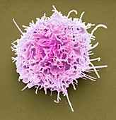 Lymphoma cancer cell.