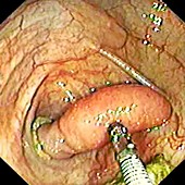 Surgically inverted appendix, endoscopic image