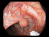Hyperplastic polyp in the colon, colonoscopy image