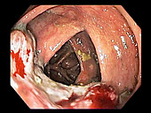 Colon cancer, colonoscopy image