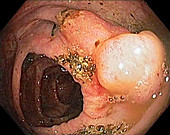 Colon cancer, colonoscopy image
